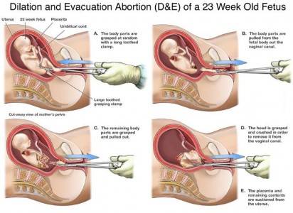D & E diagram, abortion