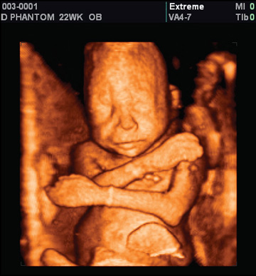 Ultrasound at 22 weeks -- when Planned Parenthood commits abortions.