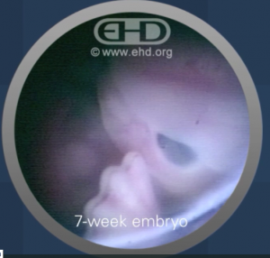 7 week old embryo, baby