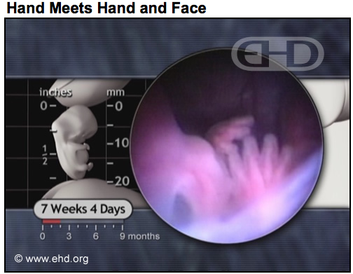 A baby at only 7 weeks, 4 days - when many abortions take place. (See www.ehd.org for more scientifically accurate photos and videos.)