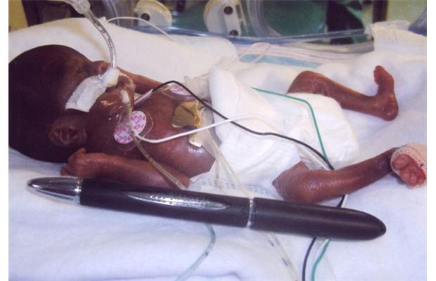 Amillia Taylor was born at only 21 weeks gestation -- and survived.