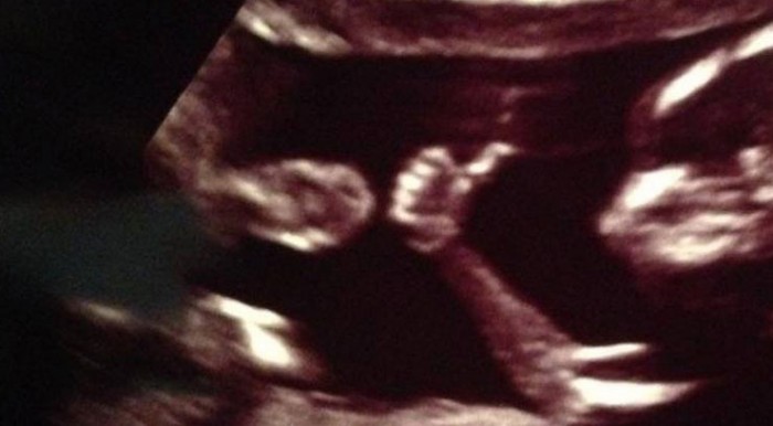 Ultrasound Baby Fetus Thumbs Up