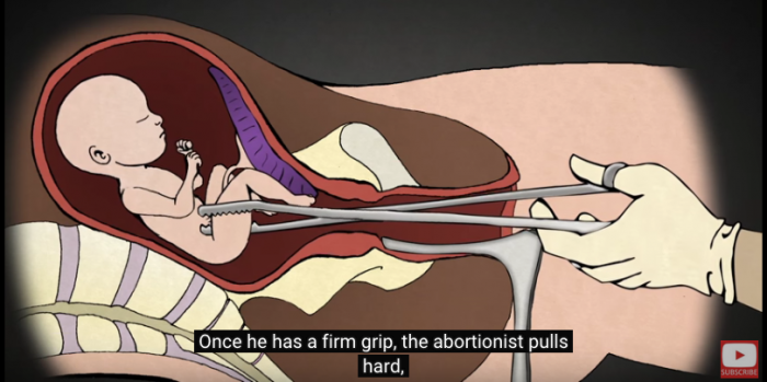 Abortion Procedures, D&E, Levatino, forceps, NAF