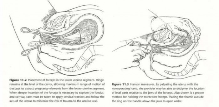 NAF abortion textbook, D&E, 16 weeks
