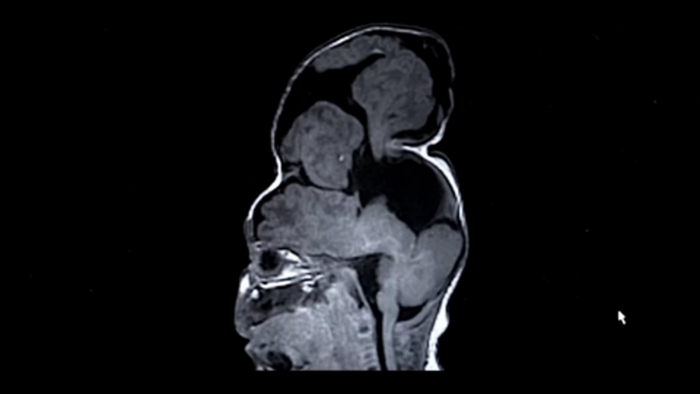 Imaging of Bentley's head from Boston Children's Hospital video.
